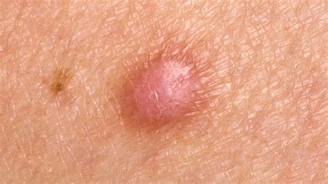 These happen when the hair curls back inside the skin, rather than growing out of the skin like normal. . Hard lump on pubic area under skin
